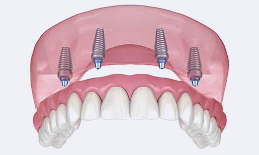 Fixed Denture