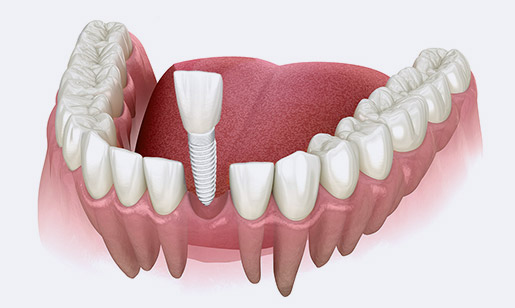 dental implants nova scotia