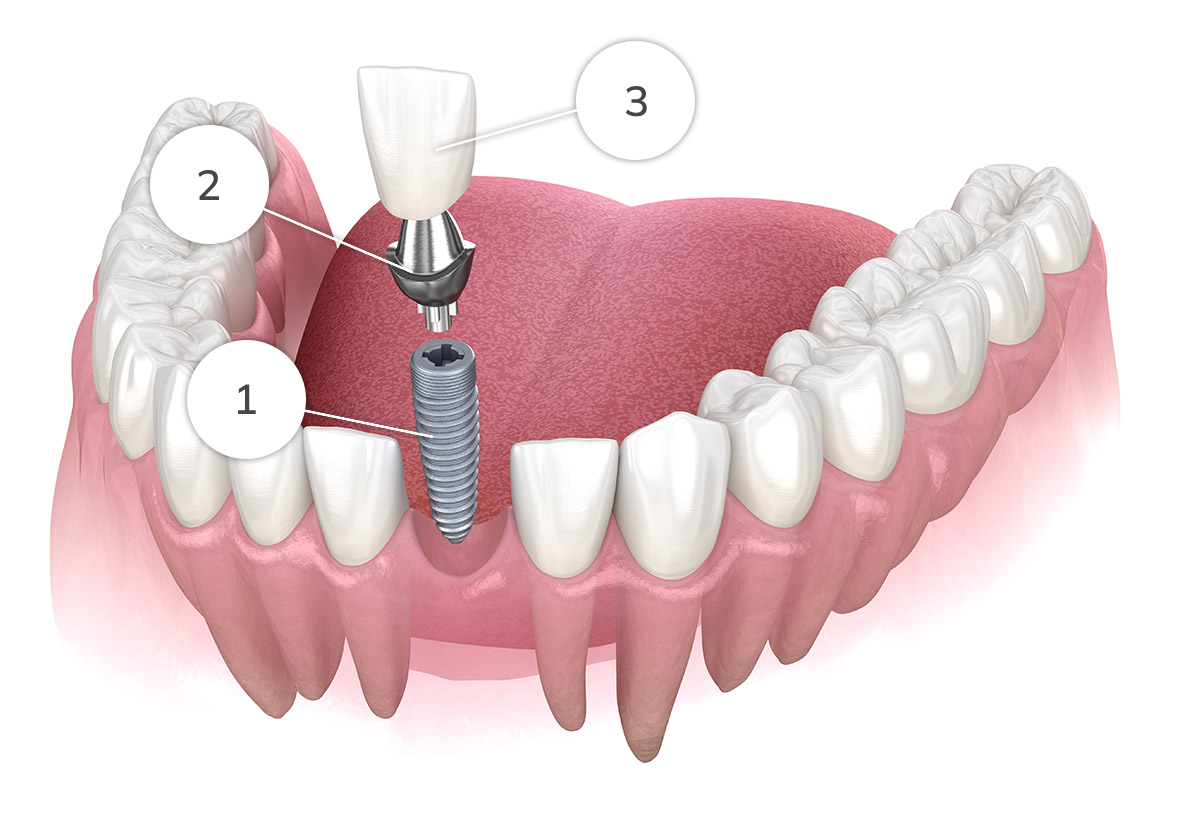 Single Diagram Titanium